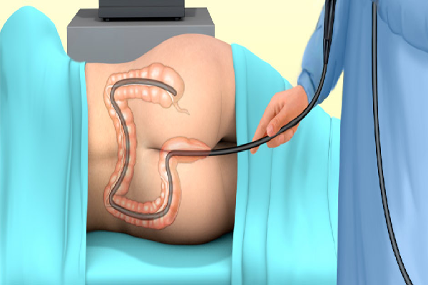 Colonscopy Procedure