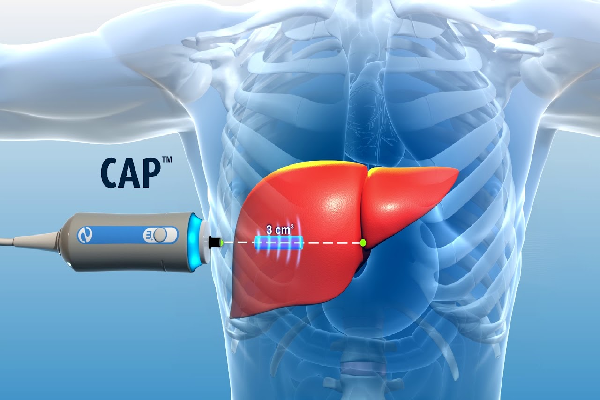 Fibroscan