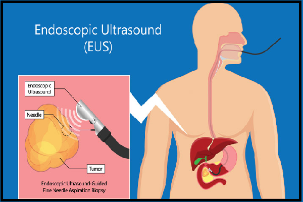 Endoscopic Ultrasound