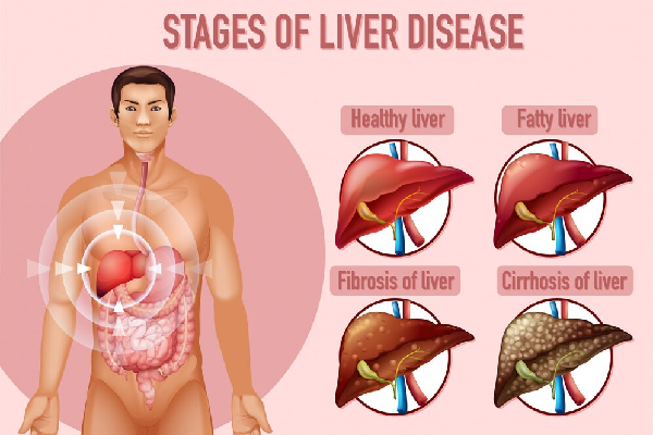 Biliary Tract Stone Disease